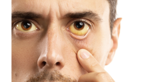 زرد شدن چشم ها به عنوان یکی از علائم کبد چرب به شمار میرود.