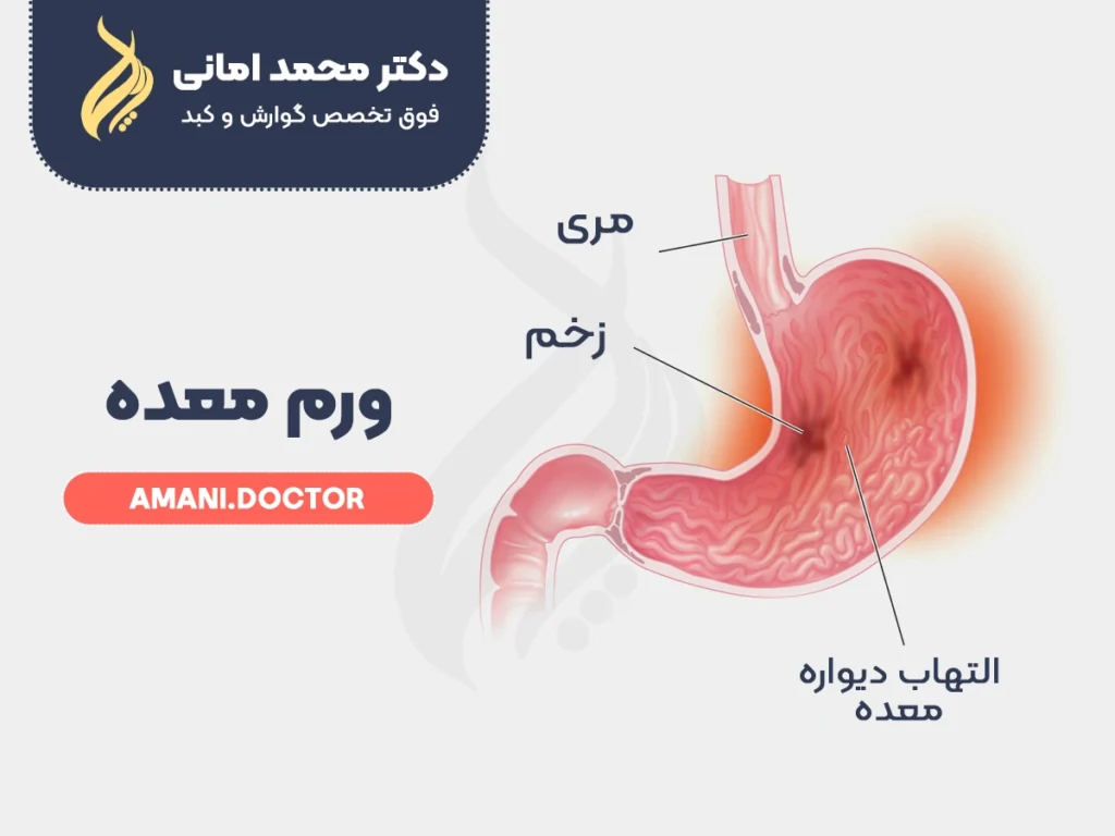 اینفوگرافیک ورم معده