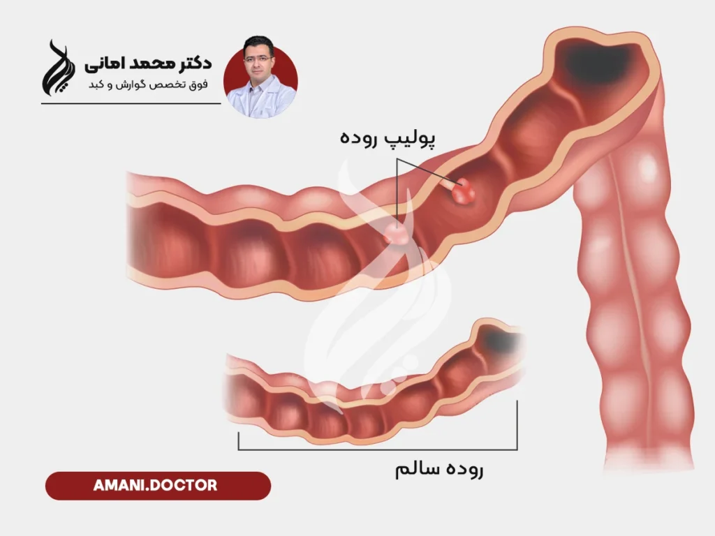 تفاوت روده سالم و پولیپ روده